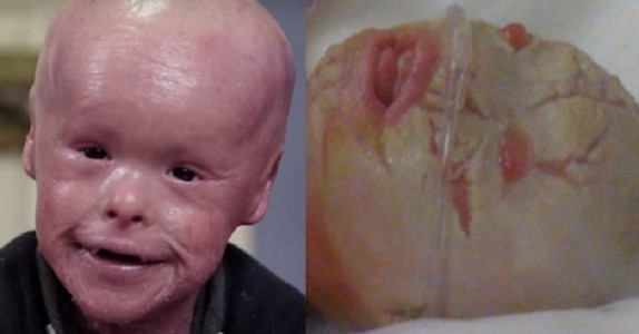 Pojken fick en dödlig sjukdom vid födseln! Nu rör hans kamp hela världen!