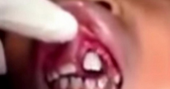 Den 10-åriga flickan kände något i hennes mun. Då upptäckte doktorn något CHOCKERANDE!