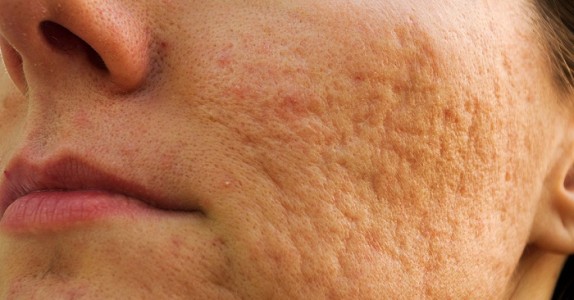 6 naturliga och effektiva sätt att bli av med ärr orsakade av akne snabbt! Så smart!