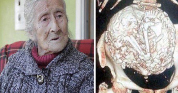 Läkare avslöjar att kvinnans 60-åriga magtumör faktiskt är hennes ofödda barn!