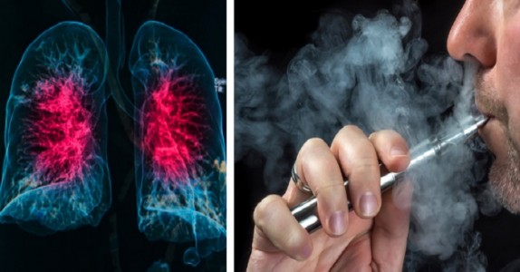Läkare varnar folk att sluta använda E-Cig, därför att de är kopplade till en ny sjukdom!