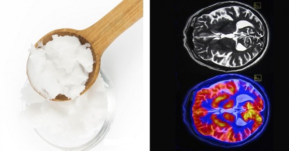 Man med alzheimers åt 4 msk kokosolja per dag under 2 månader och DETTA skedde med hans hjärna!!