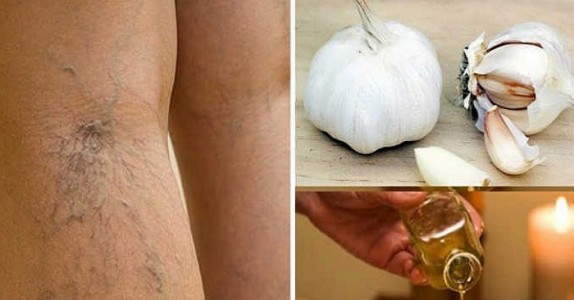 Bli av med åderbråck naturligt utan piller eller kirurgi!