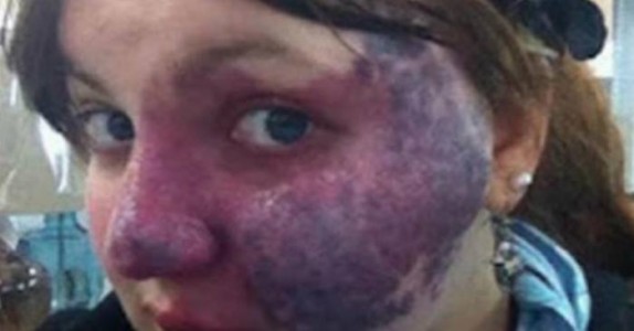 25-åringen med födelsemärke i ansiktet står i kön. Det expediten sa till henne var det sista hon väntade sig!