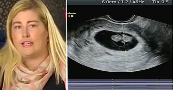 Kvinna blir gravid med tvillingar, men det är 10 dagars mellanrum mellan befruktningarna!