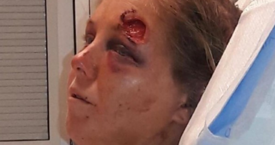 Hennes pojkvän bet henne och försökte slita ut hennes tunga! Nu har hon ett meddelande till andra kvinnor!