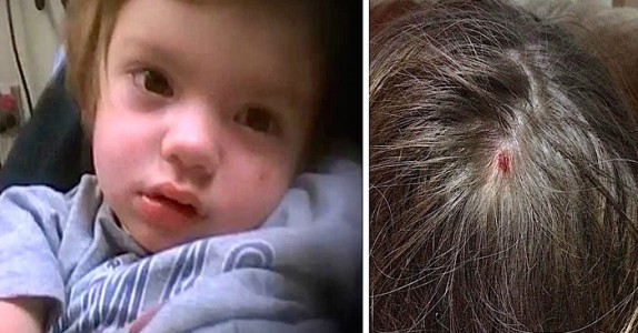 3-årig pojke vaknar FÖRLAMAD efter att de hittat ett rött bitmärke på hans huvud!